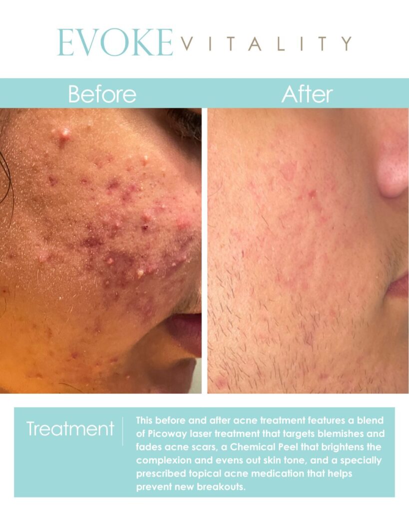 Evoke Vitality Acne Treatment Before and After