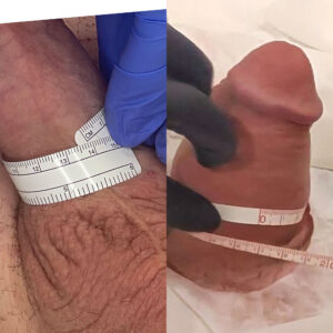non-surgical penile girth enhancement