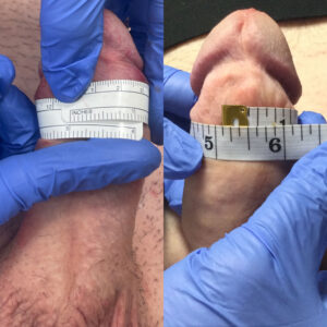 non-surgical penile girth enhancement