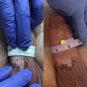 non-surgical penile girth enhancement