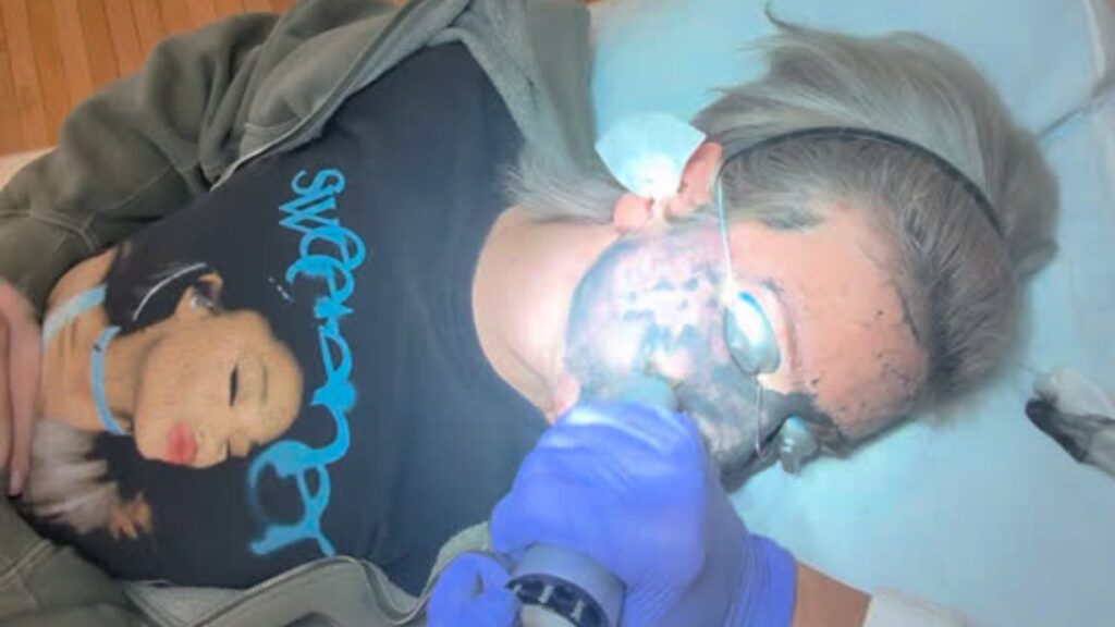 Carbon Laser Peel - Hollywood Facial in Asheville